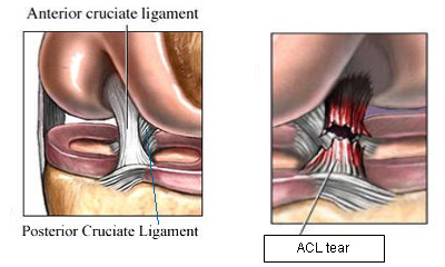 Anterior Cruciate Ligament Tears