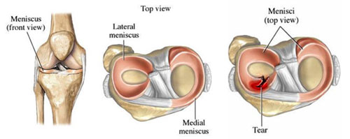 medial meniscus tear