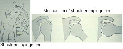 Rotator Cuff Tear