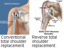 Rotator Tear