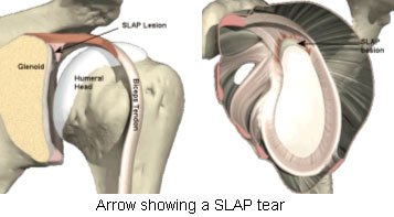Slap Tear