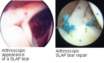 Slap Tear