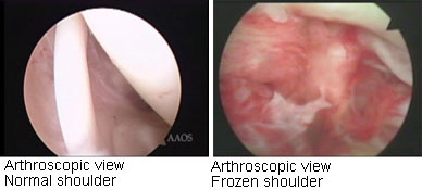 Frozen Shoulder