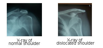 Shoulder Arthoscopy