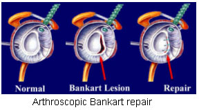 Bankart Repair