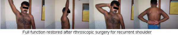 Shoulder Arthoscopy