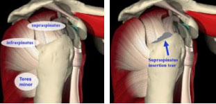 Rotator Cuff Tear