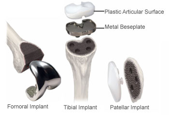 Solved] The contact between femoral and tibia components in knee joint